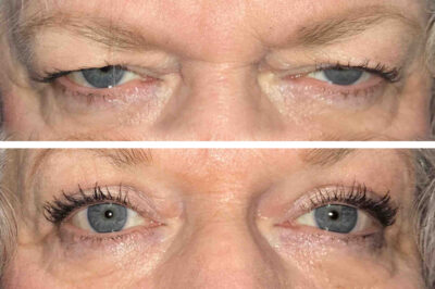 Upper Eyelid Blepharoplasty and Muellerectomy