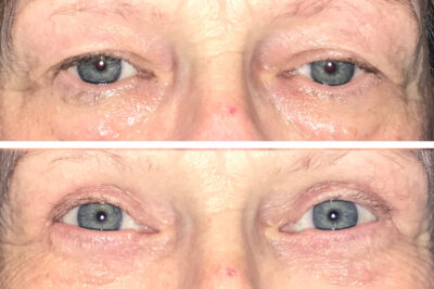 Upper and Lower Eyelid Blepharoplasty and Brow Lift