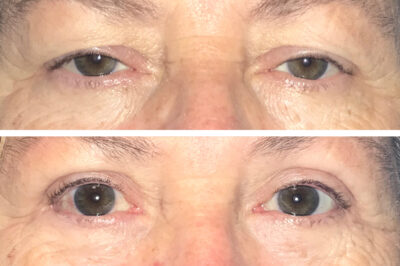 Upper Eyelid Blepharoplasty and Ectropion Repair