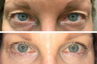 Upper and Lower Eyelid Blepharoplasty