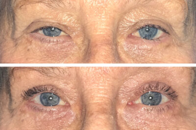 Upper Eyelid Blepharoplasty, Muellerectomy and Ectropion Repair